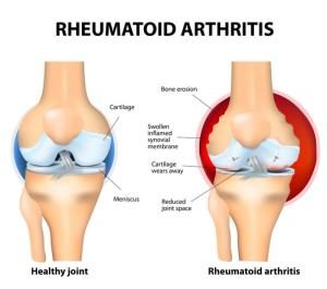 Grafik rheumatoide Arthritis