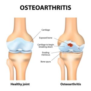 Grafik Osteoarthritis