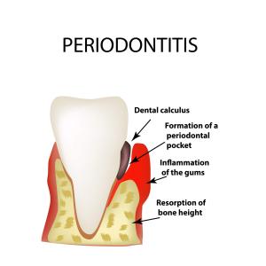 Parodontitis